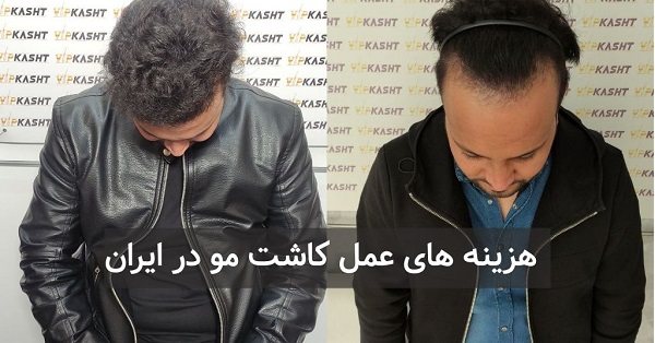 هزینه-عمل-کاشت-مو