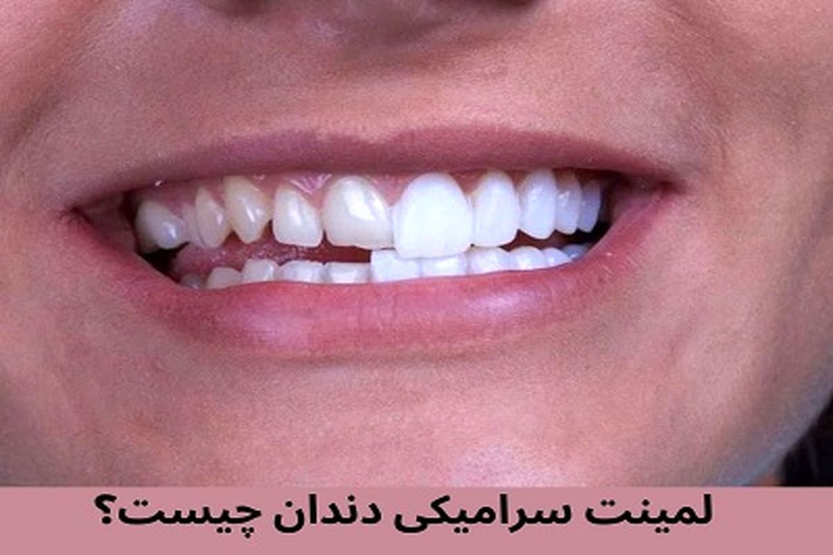 ونیر کامپوزیت بهتر است یا لمینت سرامیکی؟