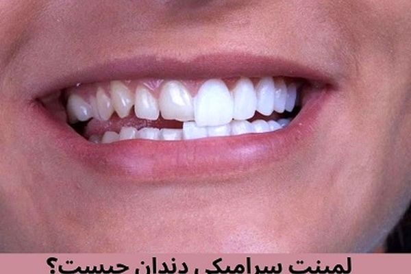 ونیر کامپوزیت بهتر است یا لمینت سرامیکی؟