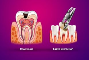 عصب‌کشی یا کشیدن دندان؛ کدام گزینه از نظر هزینه و کیفیت مقرون‌به‌صرفه‌تر است؟
