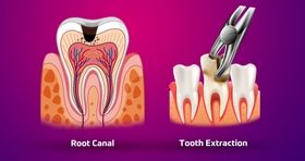 عصب‌کشی یا کشیدن دندان؛ کدام گزینه از نظر هزینه و کیفیت مقرون‌به‌صرفه‌تر است؟
