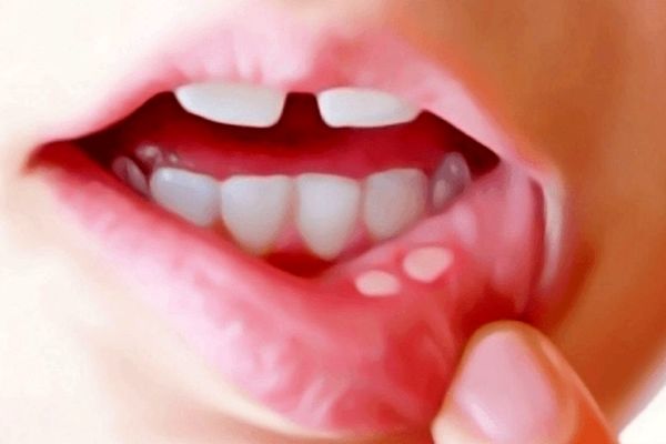 بهترین  راه درمان آفت دهان کدام است؟ 