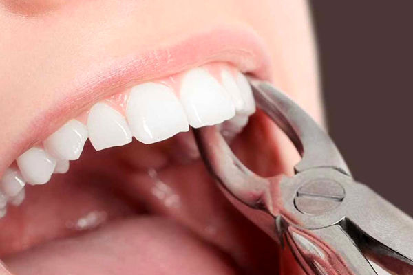 ۵ خوراکی مناسب پس از کشیدن دندان چیست؟
