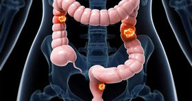 پیشگیری از سرطان روده با این روش