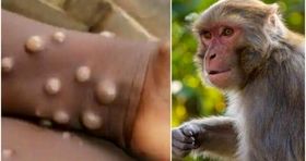 یک مورد مشکوک به آبله میمون در کشور