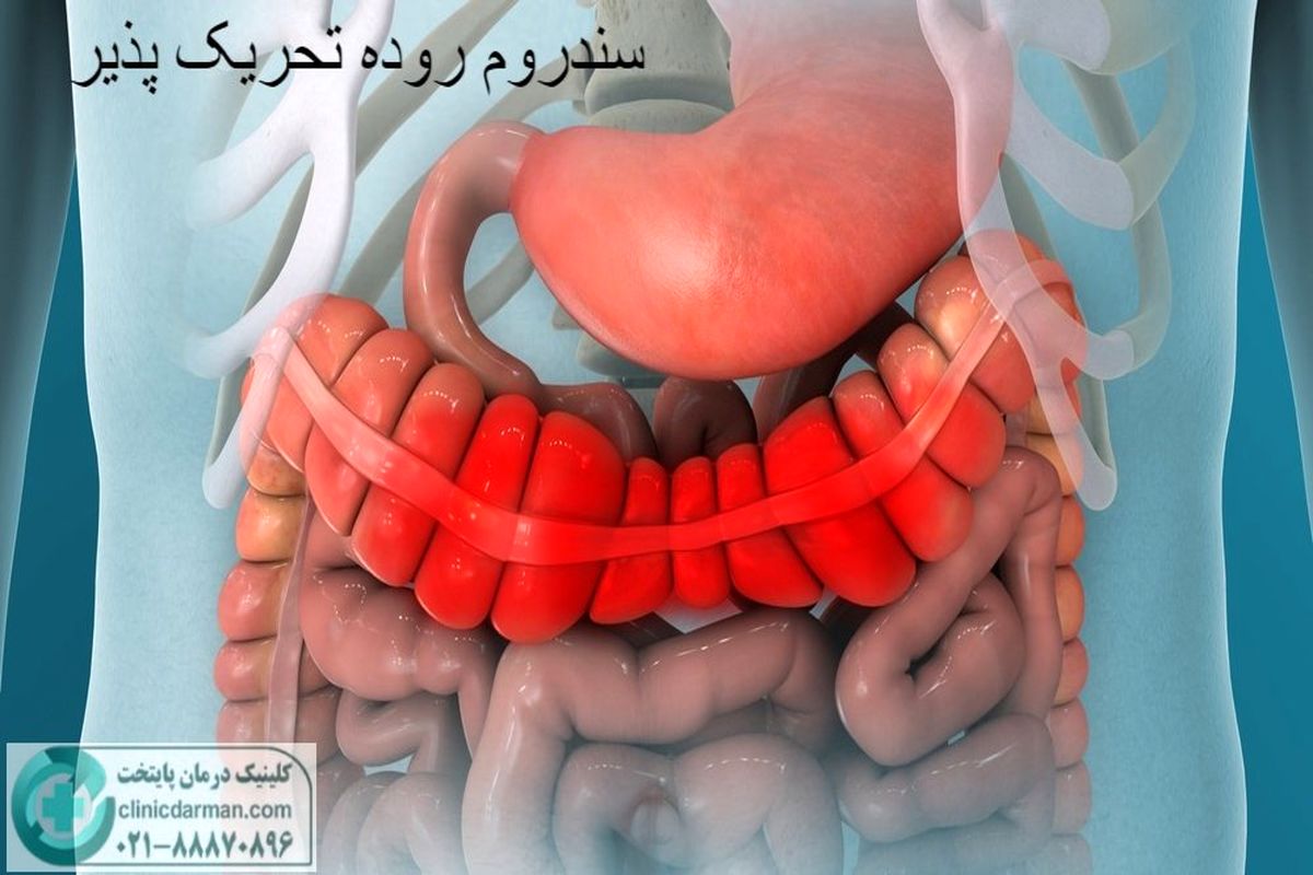 آیا سندروم روده تحریک پذیر باعث سرطان میشود [تحقیقات جدید و پزشکان چه می گویند]

