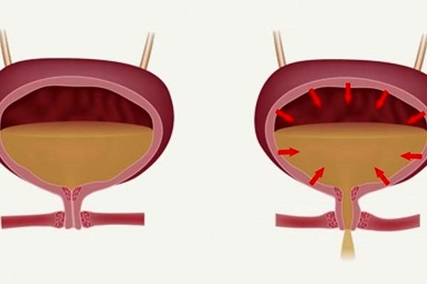 چه افرادی بیشتر دچار بی اختیاری ادرار میشوند ؟ 