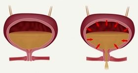 چه افرادی بیشتر دچار بی اختیاری ادرار میشوند ؟ 