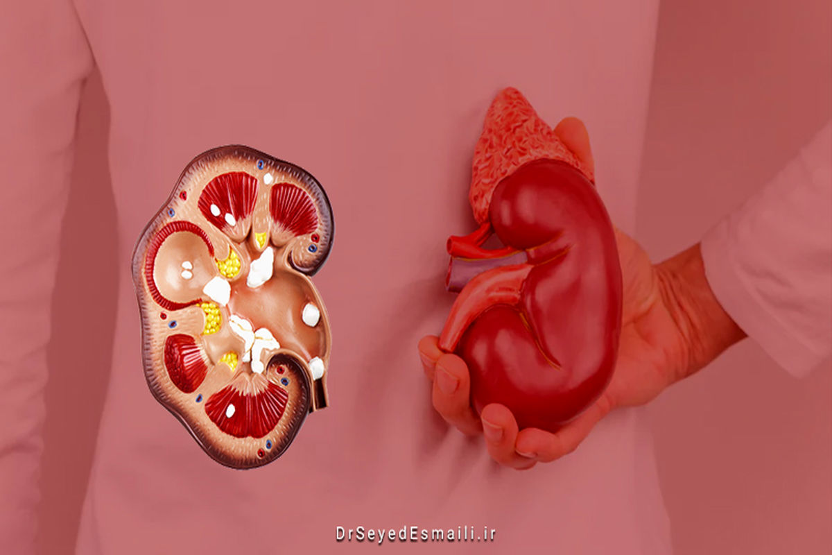 این ۸ خوراکی سنگ کلیه تشدید می کنند / تاثیر عجیب گوشت بر ابتلا به سنگ کلیه 